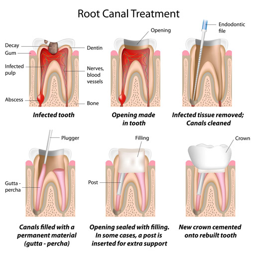 Root canal treatment